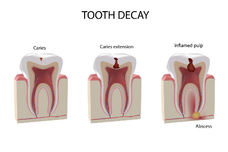 Tooth Decay Stages | Eastlake Endodontics | Chula Vista, CA